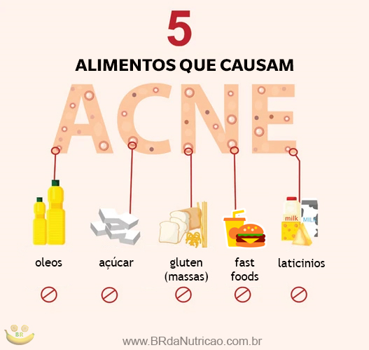 erros comuns na dieta para acne