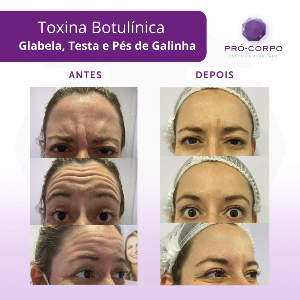 tratamento para rugas na testa